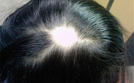 Saçkıran Nedir Kimlerde Görülür, Tedavi Yöntemleri Neler?