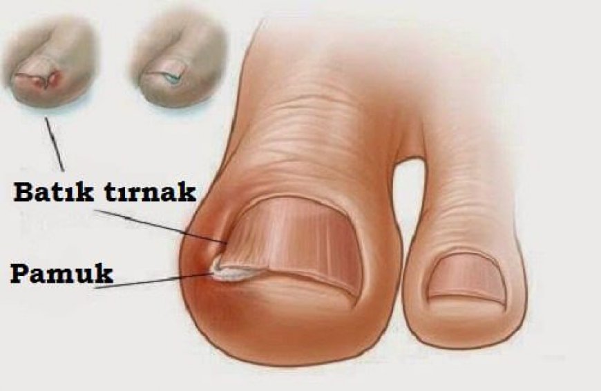 Tırnak Batması Nedir, Kimlerde Görülür Tedavisi nedir?