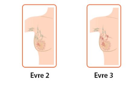 Göğüs Kanseri Erken Teşhis Belirtileri ve Tedavi Süreci